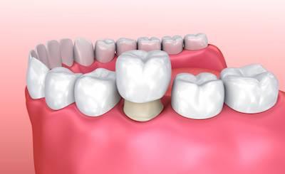 dental crown picture in Vallejo, CA
