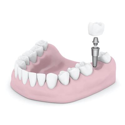 dental implant post illustration