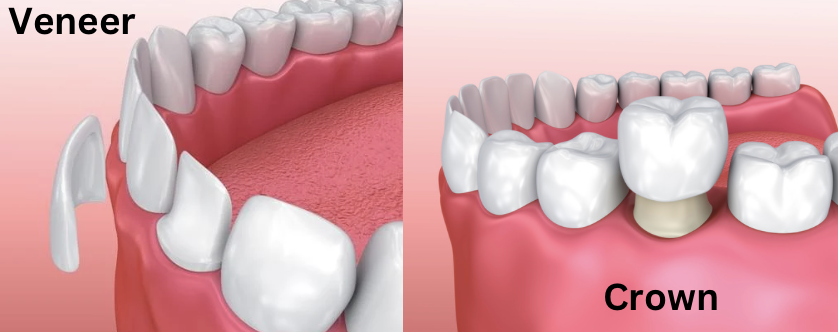 veneer and crown illustration