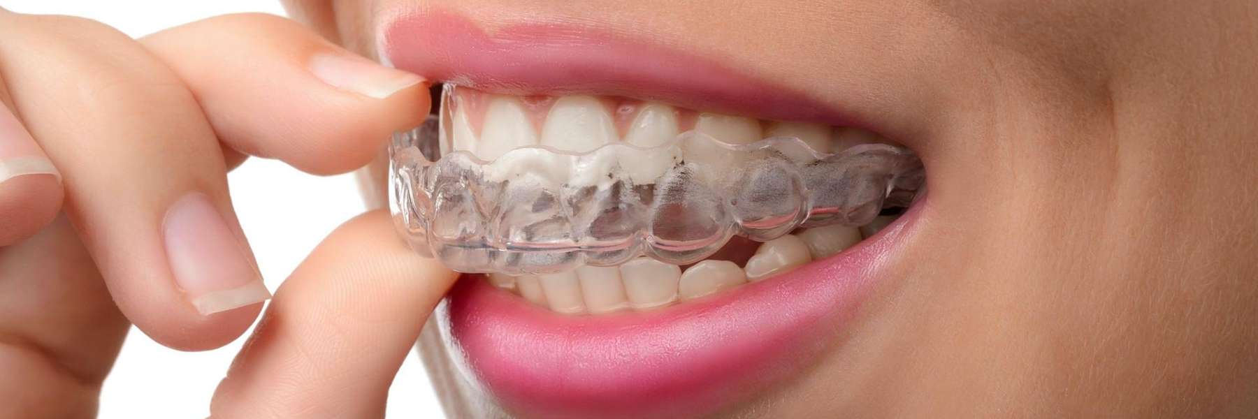 Invisalign in the mouth