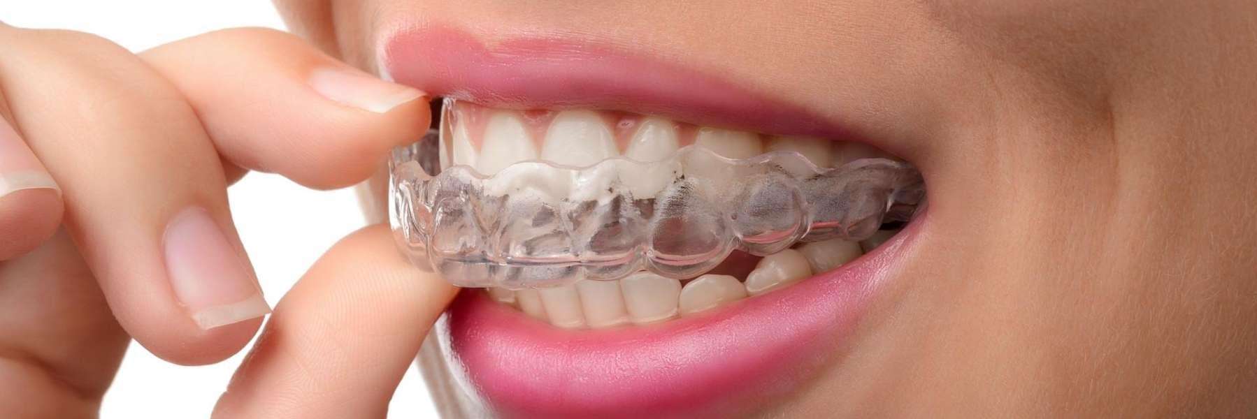 invisalign provider vallejo ca