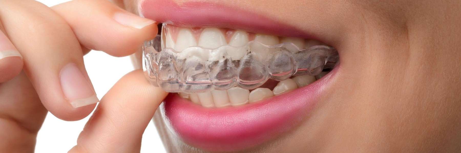 Invisalign in the mouth