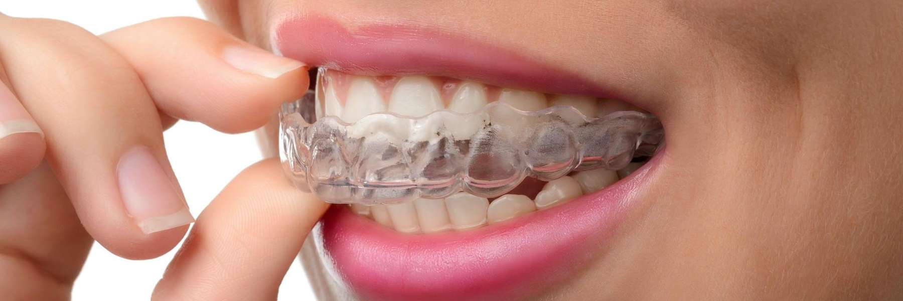 Invisalign in Vallejo CA