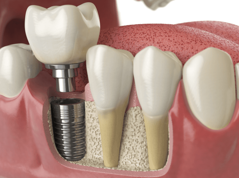 dental implant in the jaw