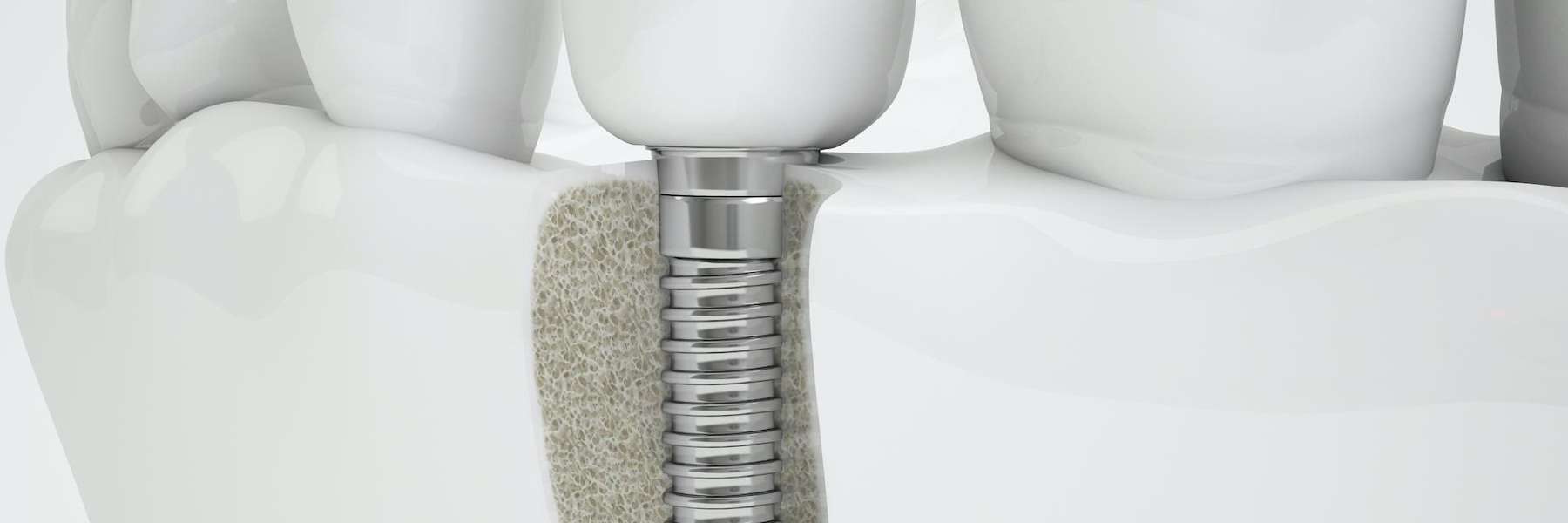 dental implant post