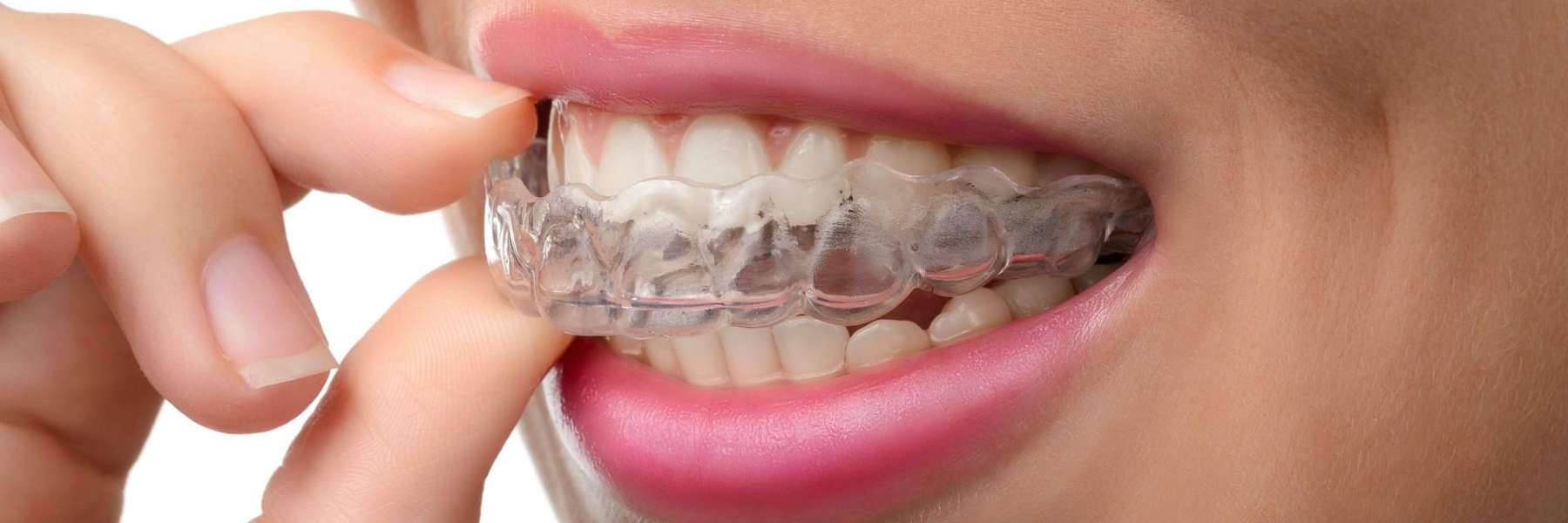 Invisalign out of the tray