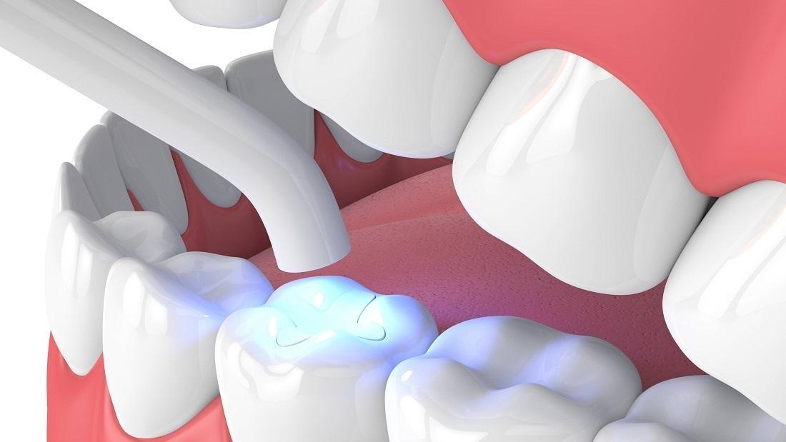The Benefits of Composite Fillings Over Amalgam Vallejo Dentistry